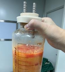 咸宁水动力吸脂手术要做多久？